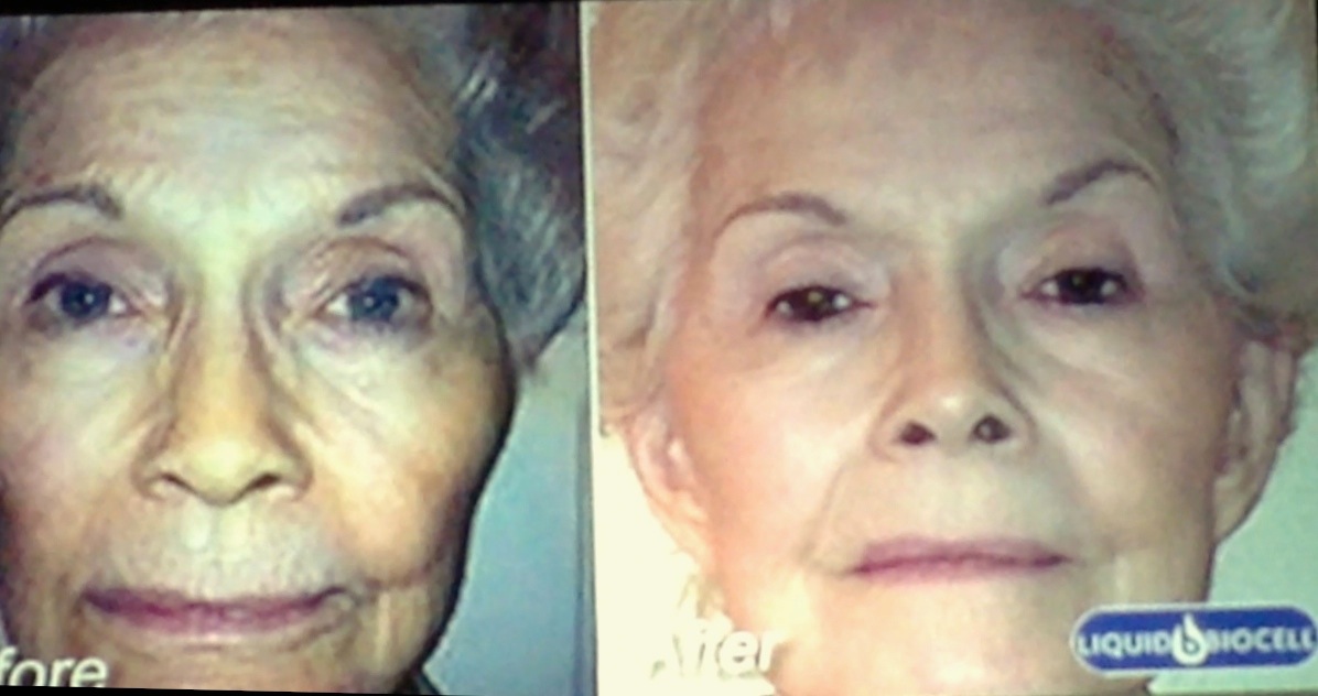 Thera started taking this supplement and look how it's improved her facial features and her skin as well as her hair.